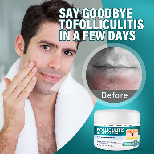 Dijkoo Crema De Foliculitis, Tratamiento De Foliculitis Para