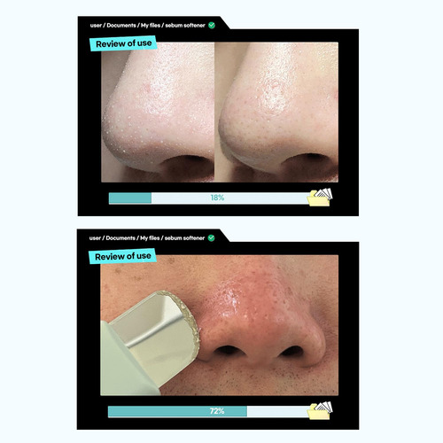 Solución Limpiadora De Poros Ilso Super Melting Sebum Soften