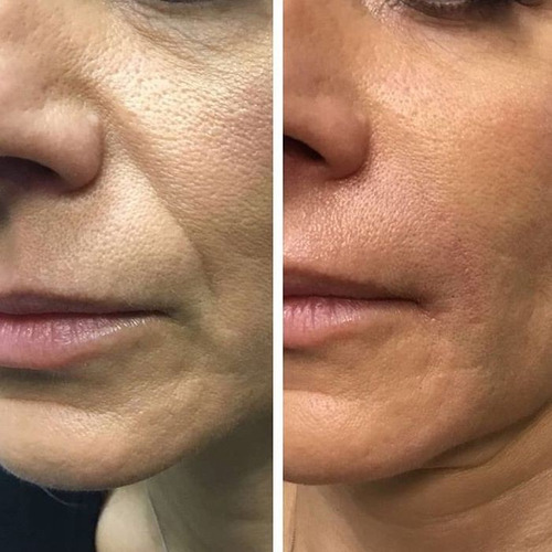 Sesion Hifu 7d Rostro + Cuello + Papada +escote