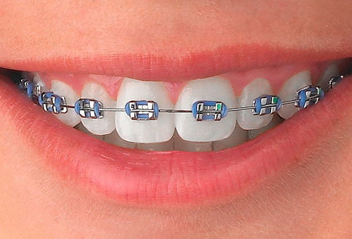 Ortodoncia Con Brackets Zafiro