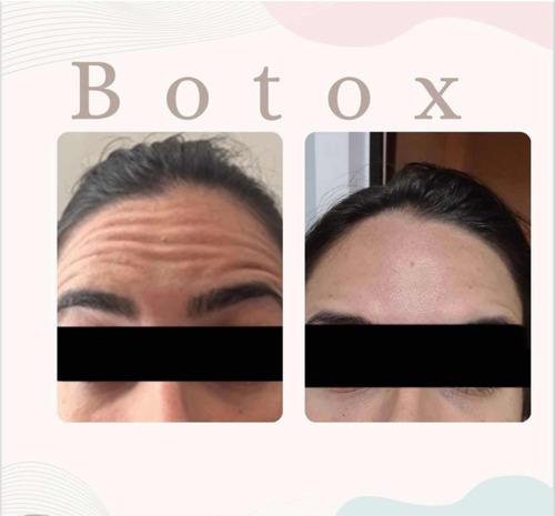 Aplicación De Botox (toxina Botulínica)