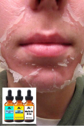 Peeling 3d + Retinoico + Tca+ Tioglicolico 10ml+ Vitamina C