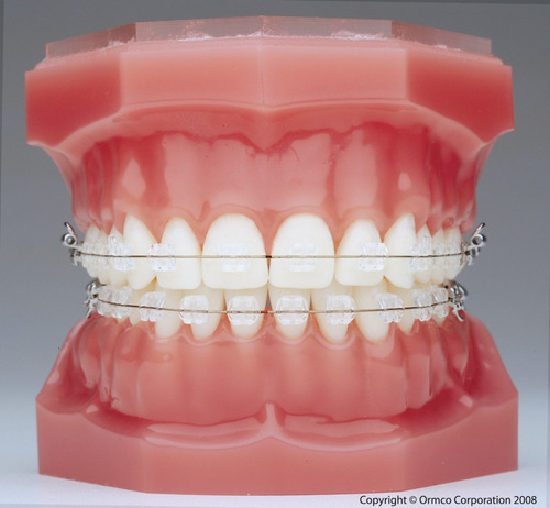 Imagen 5 de 10 de Tratamiento Ortodoncia - Brackets Porcelana Esteticos