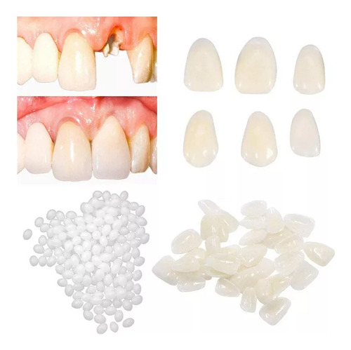 12 Dentes Provisórios Coroas A2 + Massa Fixadora (bolinhas )