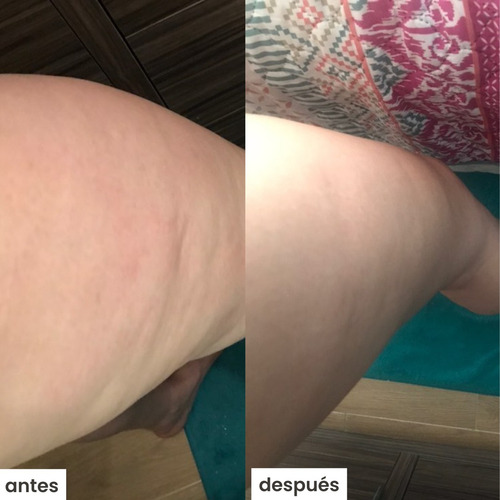 Kit Azala S/ Ventosa- Tratamiento Para Celulitis Cítrica