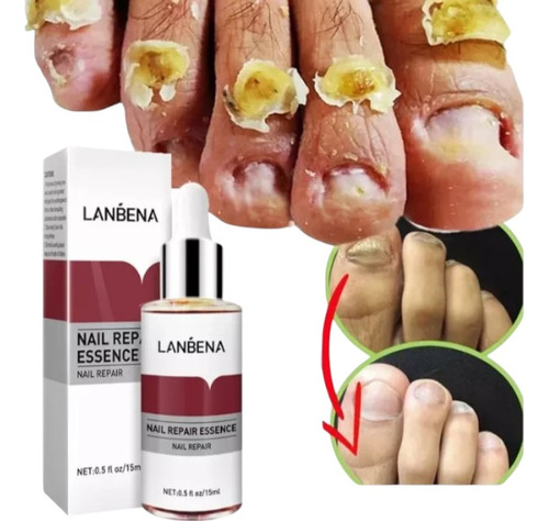 Formula Mejorada Suero Elimina Hongos En Uñas De Pie Y Mano