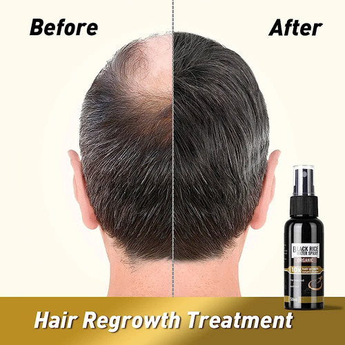 Suero De Arroz Negro Para Crecimiento De Cabello Y Barba