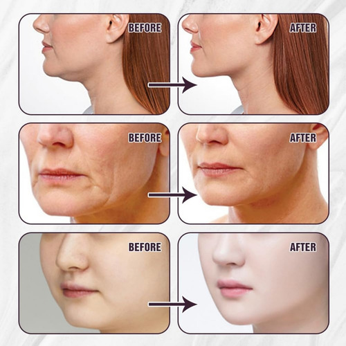 Cinta De Estiramiento Facial Invisible, Aspecto Natural