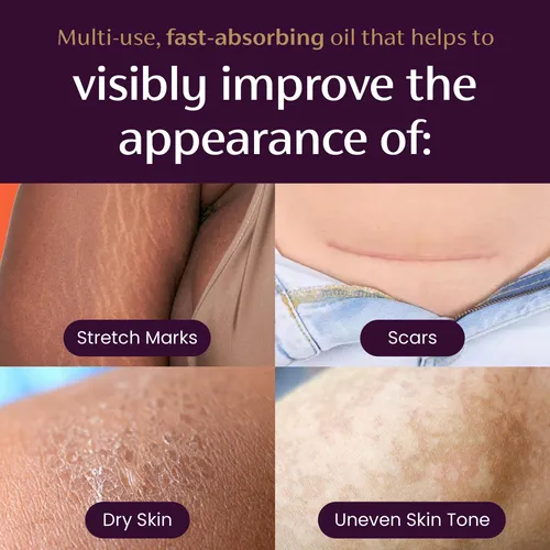 Tratamiento De Cicatrices Y Estrías Mederma Quick Dry Oil 60