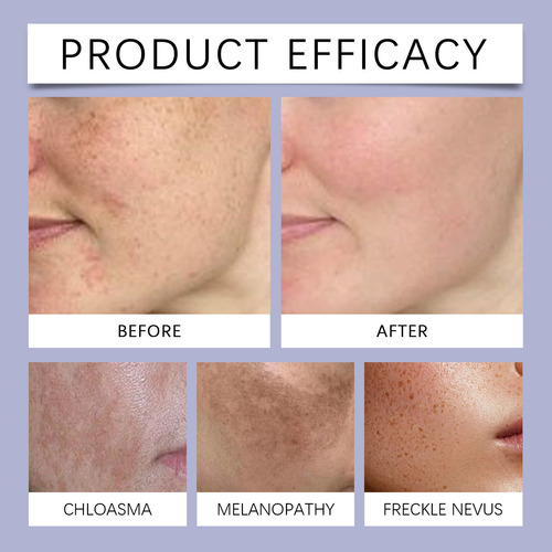 La Crema Aclaradora De Manchas Faciales F Ilumina La Piel Y
