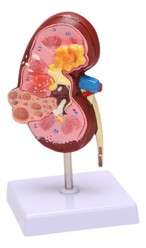 Patologías Renales Modelo Anatomía Del Cuerpo Humano: