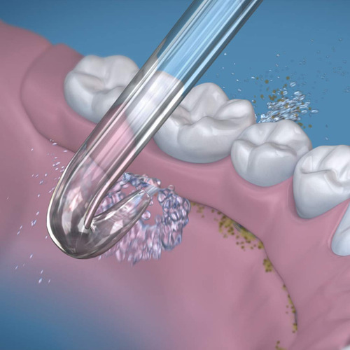 Substituição Da Ponta Do Fio Dental Waterpik Dt-100e 2 Unida