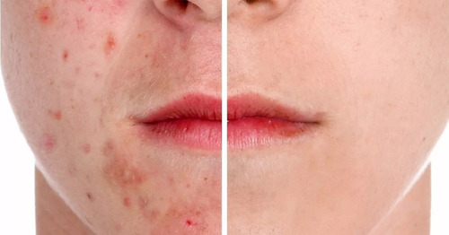 Crema Acido Salicilico Topico Rostro Facial Envio Gratis