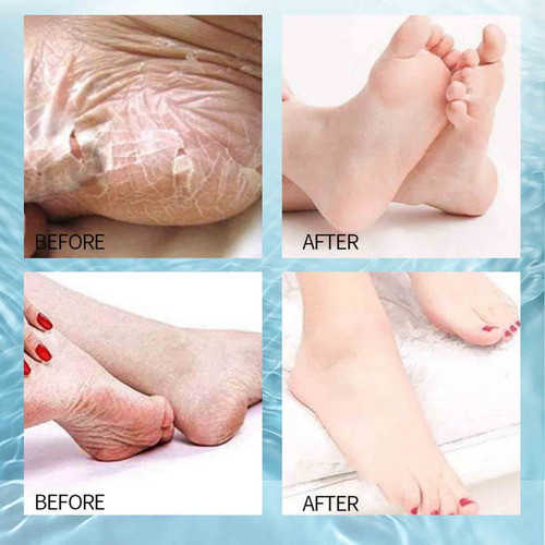 Foot Peel Mask Skin Calluses Repairing Exfoliant 10ml Remove