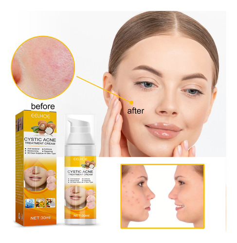. Crema For Tratar El Acné: Combate El Acné Hormonal