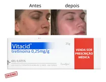 Comprar Vitacyd 0,25mg Gel Facial +12 Acne Melasma Rugas Manchas. Todo Tipo De Pele Noite