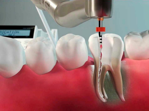 Motor Endodontia Sem Fio 16:1 Reciprocante Rotatório Led