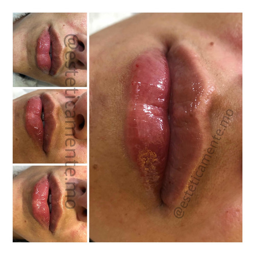 Imagen 1 de 5 de Relleno De Labios