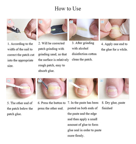 Set De Corrección De Uñas Encarnadas, Tratamiento Para Uñas