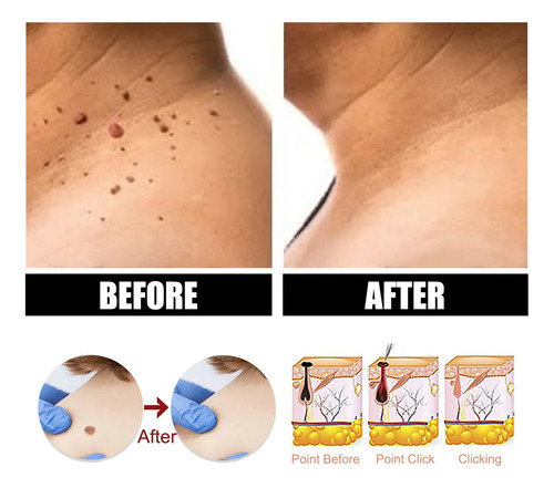 2. Elimine Las Verrugas Del Cuello, El Cuerpo Y Los Pies.