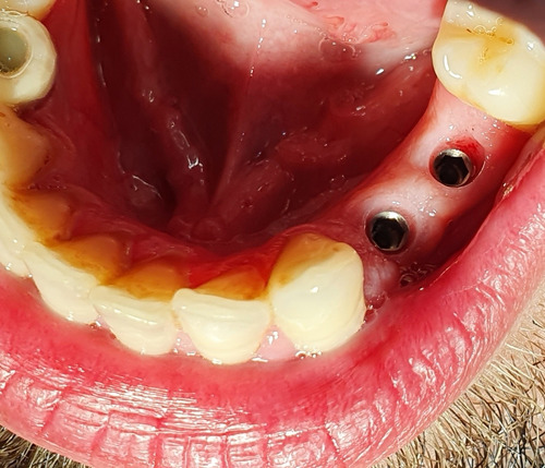 Imagen 1 de 2 de Implantes Dentales