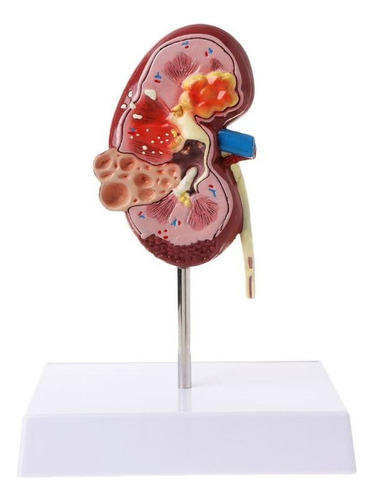 Life Human Size Diseased Kidney Anatomical Model Anatomy D