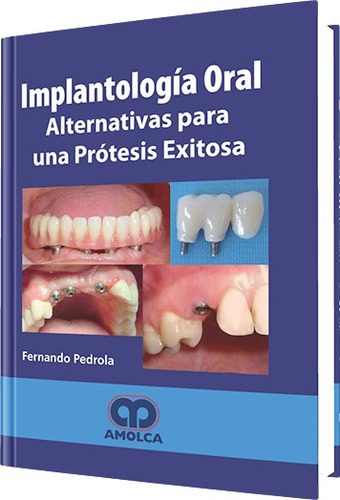 Sobredentaduras Implantosoportadas /  Sanfilippo / Amolca