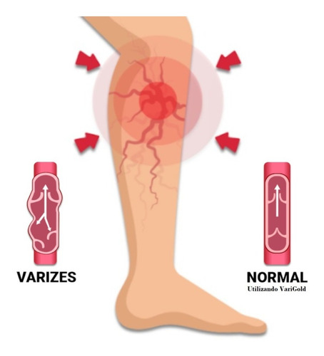 4x Hidratante Corporal Pernas Tratamento Varizes Varigold