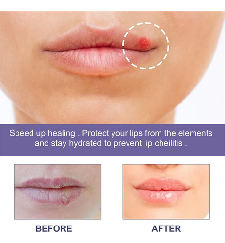 3×parches Suavizantes Para Herpes Labial Parche Curativo