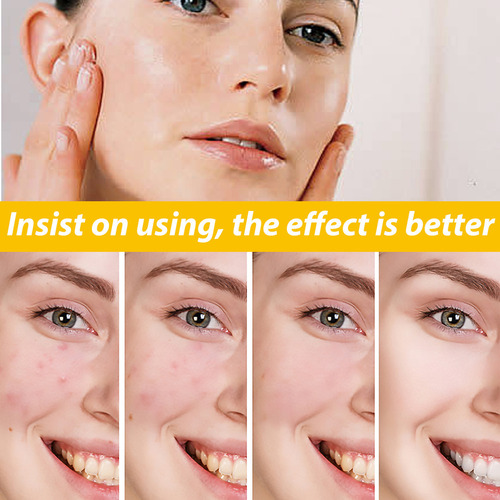 . Crema For Tratar El Acné: Combate El Acné Hormonal