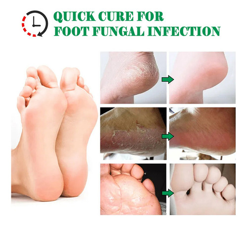 Crema Exfoliante Y Para El Cuidado De Pies Podridos Con Olor