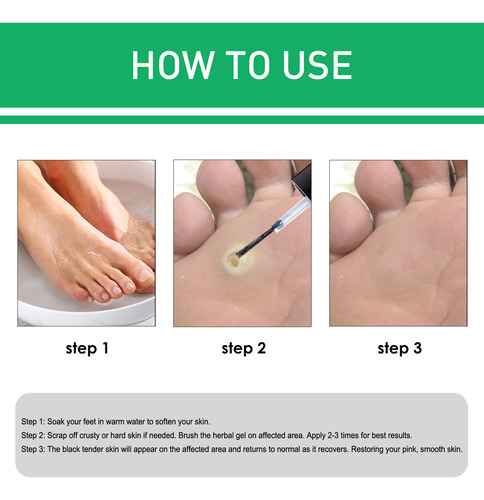 Solución Para Verrugas Y Ojos De Pollo De 10 Ml, 2 Piezas Pa