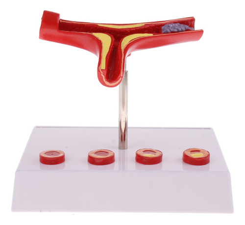 Modelo De Vascular De Trombo De Aterosclerosis De Vaso