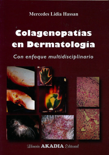 Colagenopatias En Dermatologia - Hassan, Mercedes Lidia