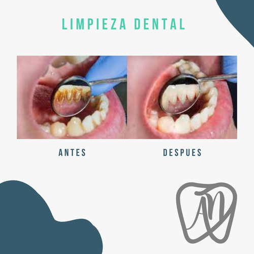 Imagen 2 de 4 de Limpieza Dental Con Ultrasonido Y Aeropulido + Fluor