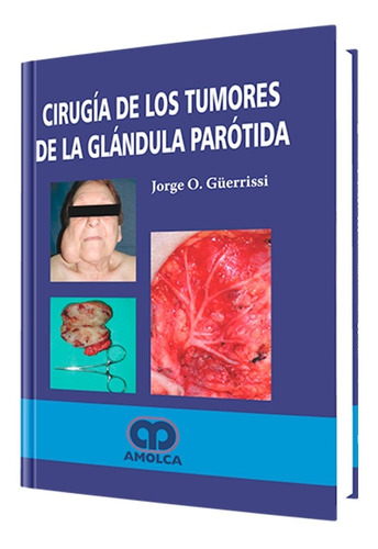 Cirugía De Los Tumores De La Glándula Parótida.