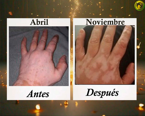 Cenit, Kit Tópico Para Piel Con Vitíligo