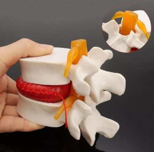 Modelo De Vértebras Lumbares: Columna Anatómica Hernia D