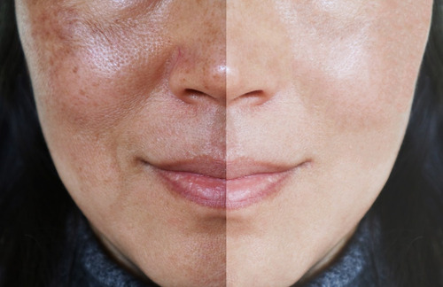 Serum Crema C Elimina Manchas Paño Pecas Aclarante Anti Edad Tipo De Piel Normal
