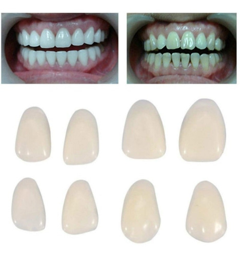 Facetas  Dentárias Sup E Inf    12 Peças Na Cor A1