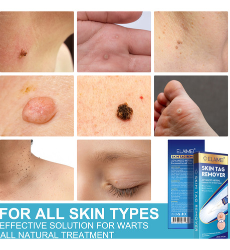 Caneta De Remoção De Verrugas Para Remover Caneta Para