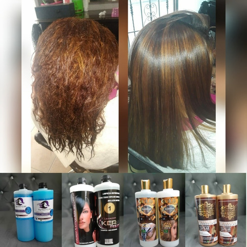 Imagen 3 de 4 de Cirugía Capilar El Mejor Tratamiento Para Tu Cabello