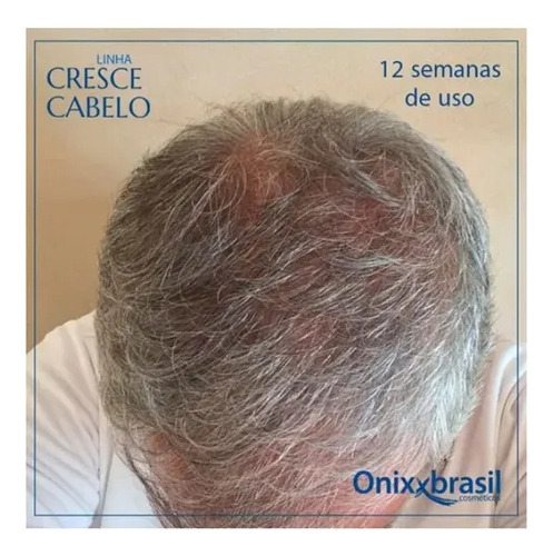 Tônico Capilar Nasce Cabelo Onixx Brasil 120ml Shampoo Minox