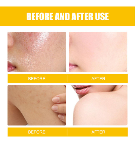. Crema For Tratar El Acné: Combate El Acné Hormonal