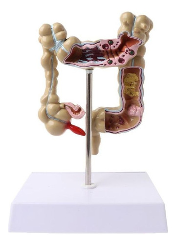 Modelo De Intestino Grueso Con Lesión De Colon Humano