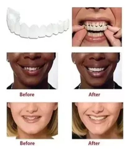 I Carillas De Dientes Postizos De Sonrisa Superior Inferior