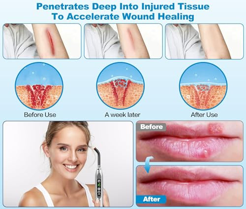 Tratamiento De Herpes Labial Y Ampollas Febriles Con Terapia