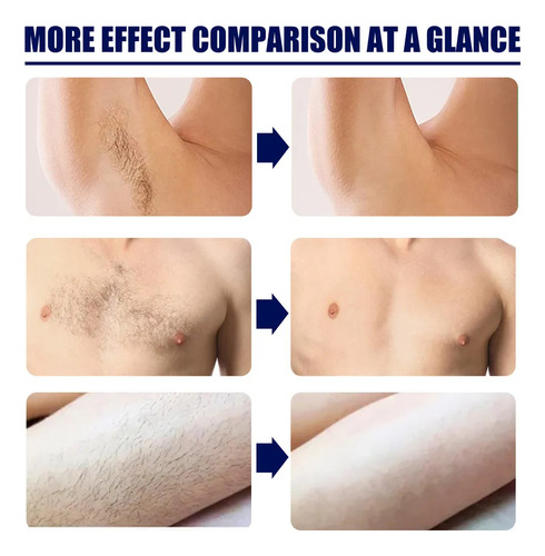 Creme De Depilação: Remove O Cabelo Para Barbear.