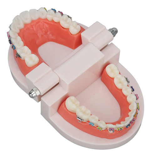 Modelo De Dientes De Ortodoncia Con Soportes De Metal De