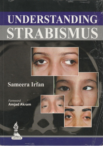 Understanding Strabismus Sameera Irfan